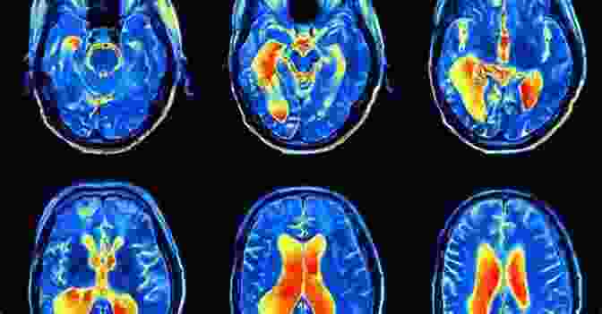 FMRI Image Showing Brain Activity During A Seizure Functional MRI: Applications In Clinical Neurology And Psychiatry