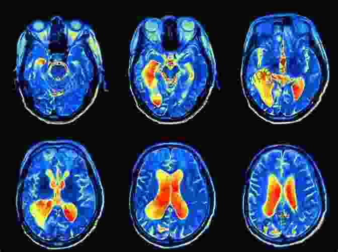 FMRI Image Showing Brain Activity In Schizophrenia Functional MRI: Applications In Clinical Neurology And Psychiatry