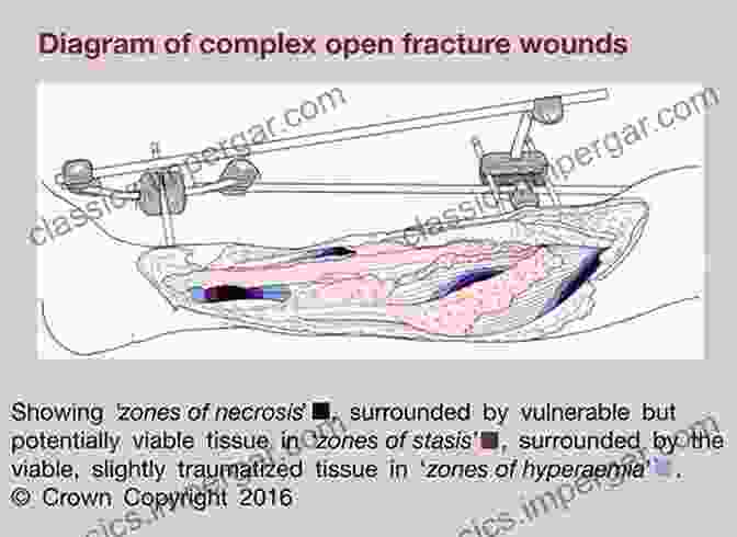 Open Fracture And Wound Management Emergency Room Orthopaedic Procedures: An Illustrative Guide For The House Officer